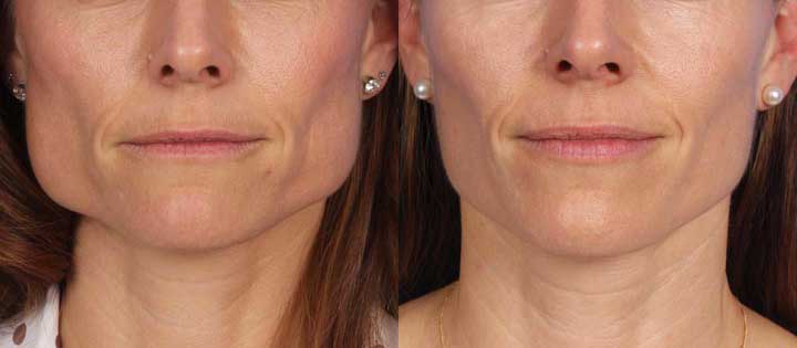 masseter jaw reduction