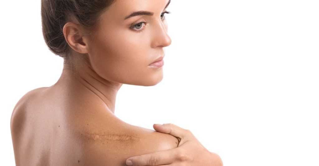scar removal