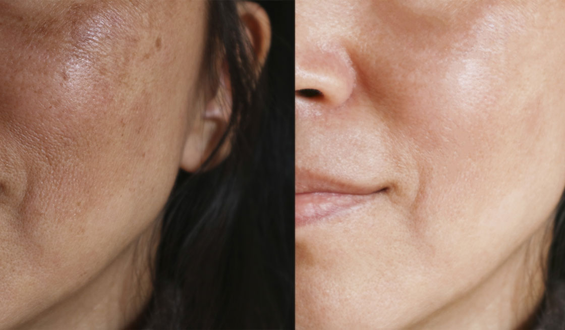 Chemical Peels SDbotox