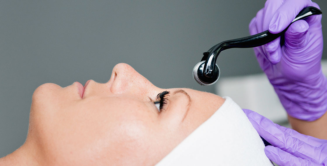 microneedling