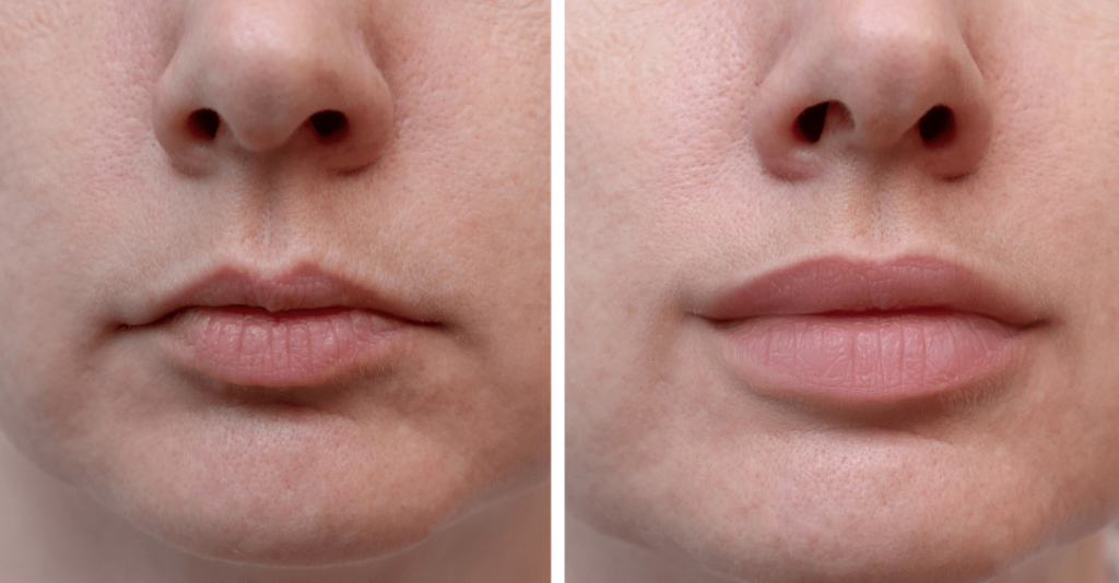 Lip filler before and after