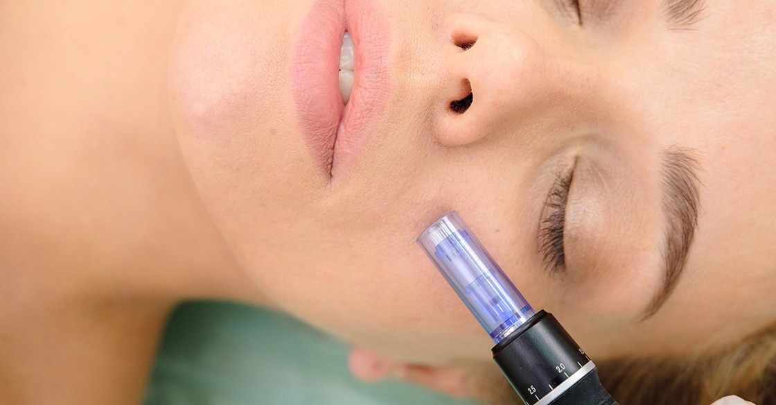microneedling