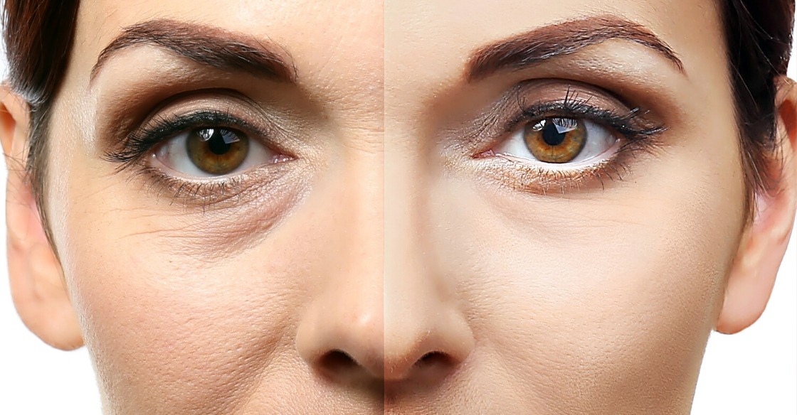 Before and after botox