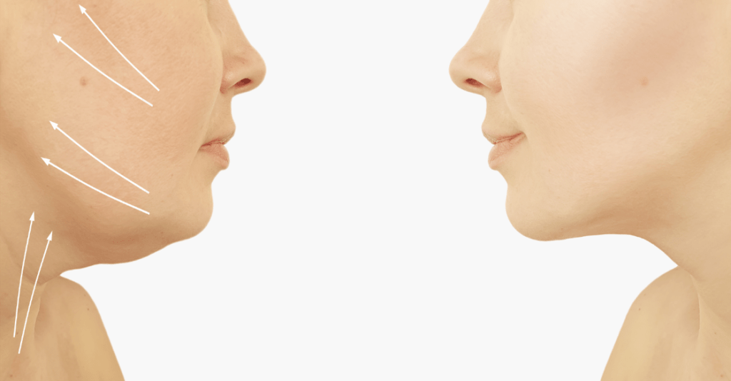 Dermal filler neck and face injection before and after