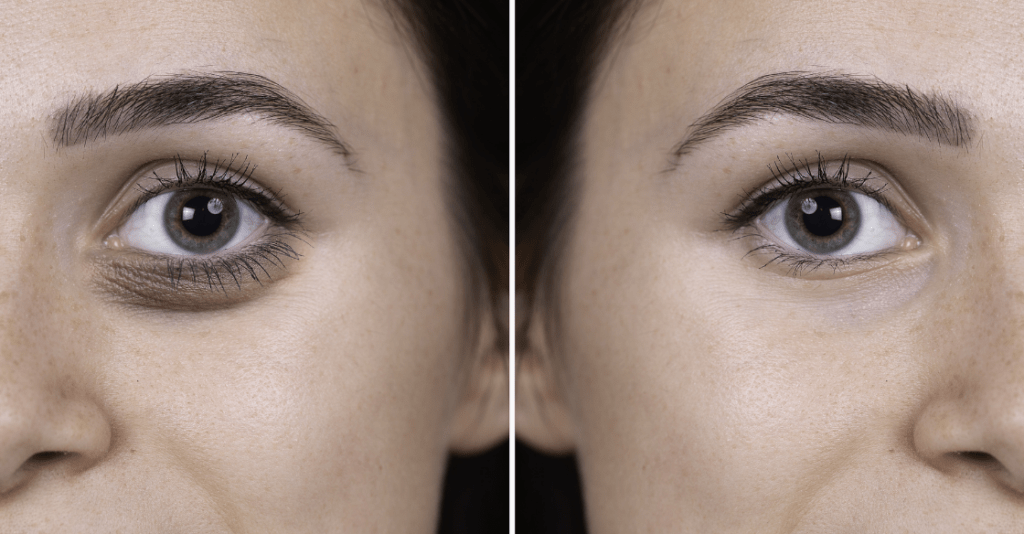 Under eye rejuvenation with dermal filler before and after