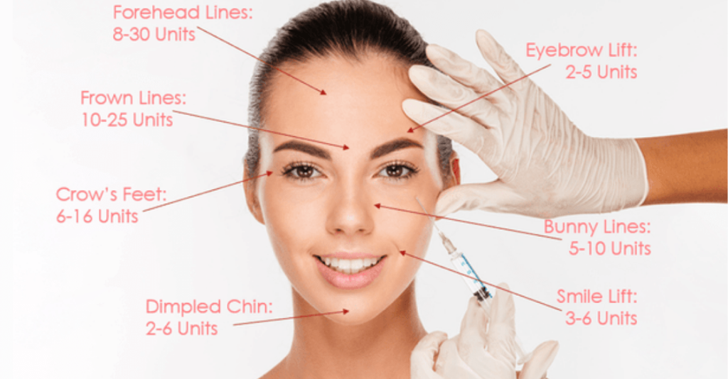 Units needed of Botox for different treatment areas of the face