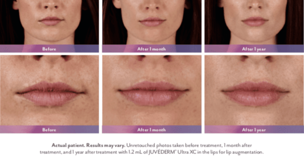 Results of lip filler