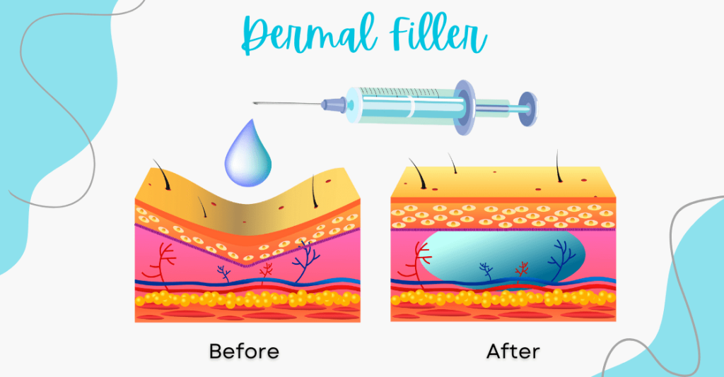 How dermal filler works graphic