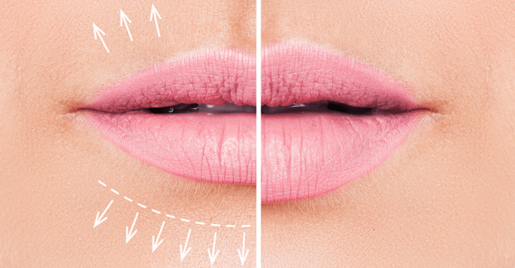 lip filler before and after