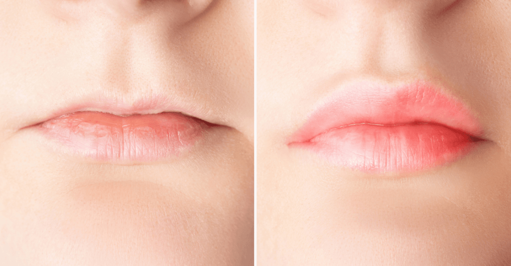 filler lip injection before and after