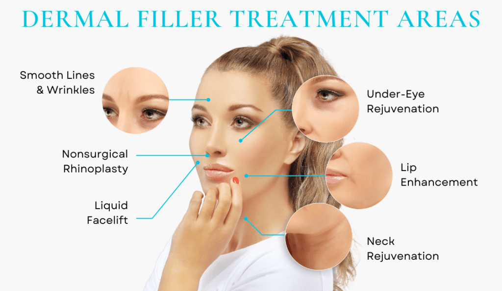 Dermal filler treatment areas graphic