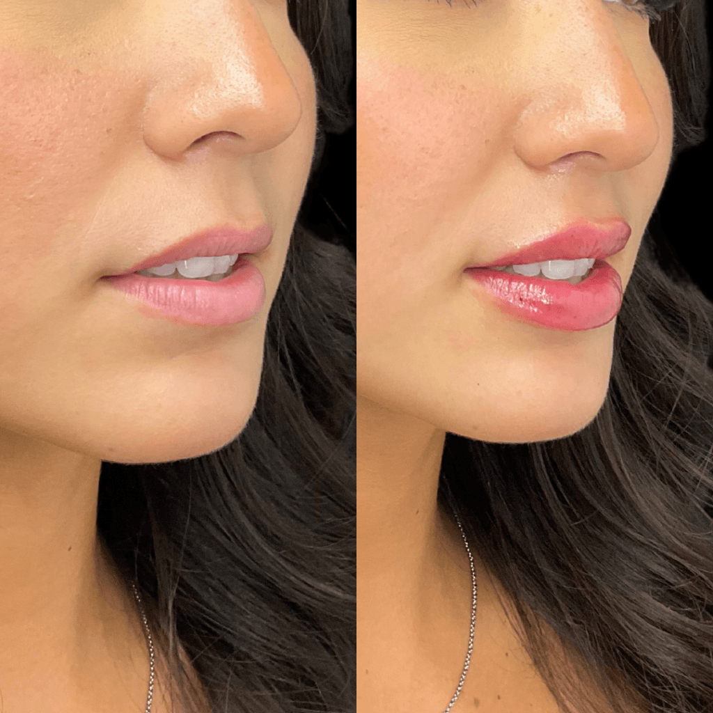 lip filler in san diego