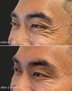 Before and after Botox for crow's feet on SDBotox client in San Diego