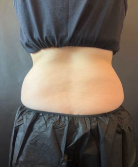 After image of the back before CoolSculpting for love handles