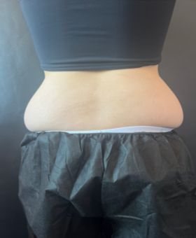 Before image of the back before CoolSculpting for love handles