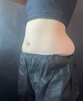 Before image of the stomach before CoolSculpting for love handles