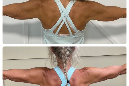 Before and after CoolSculpting for arms from the back