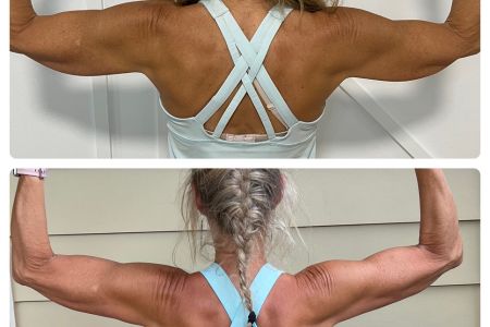 Before and after CoolSculpting for arms from the back with arms bent