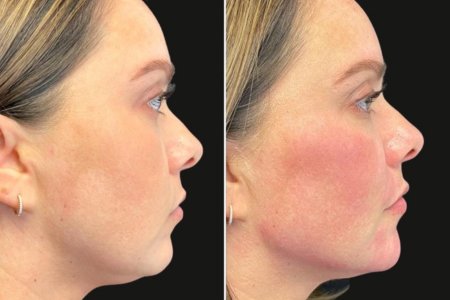 An SDBotox client showing before and after cheek fillers from the side