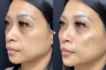 An SDBotox client showing before and after cheek fillers from the left side