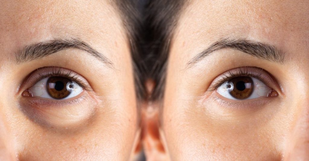 Before and after of Morpheus8 under eyes on a plastic surgery patient