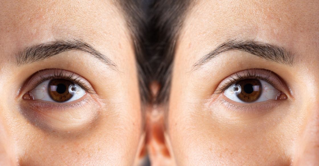 Before and after of Morpheus8 under eyes on a plastic surgery patient