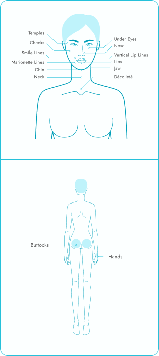 Dermal Filler Chart | SDBotox