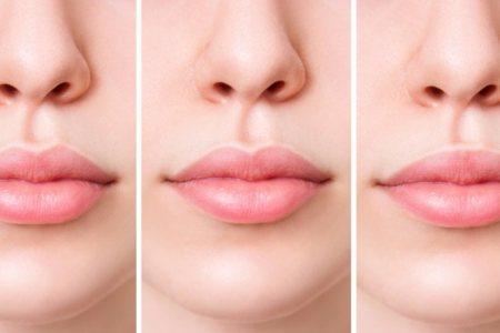 Three people with different types of lip filler shapes