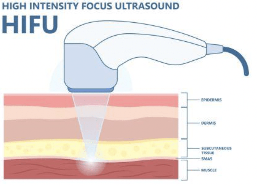 Cross section of human tissue and CoolSculpt device targeting fat