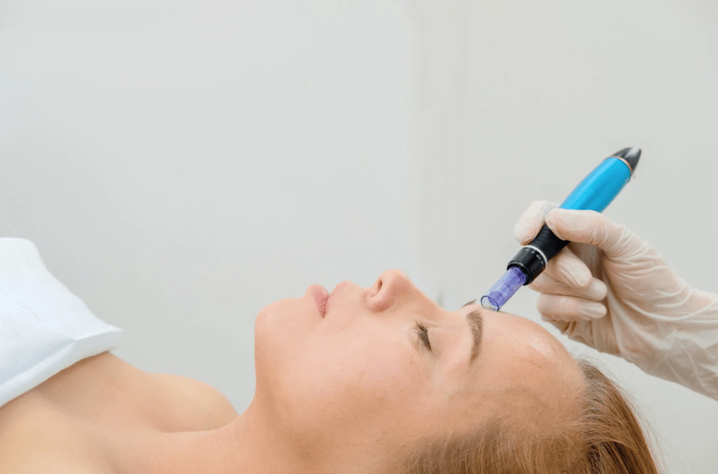 morpheus8 microneedling treatment