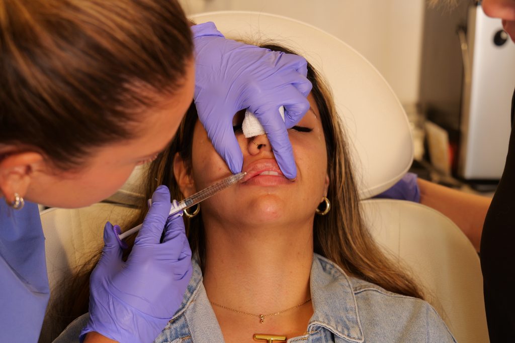 Lip filler injections with Juvederm HA filler product.