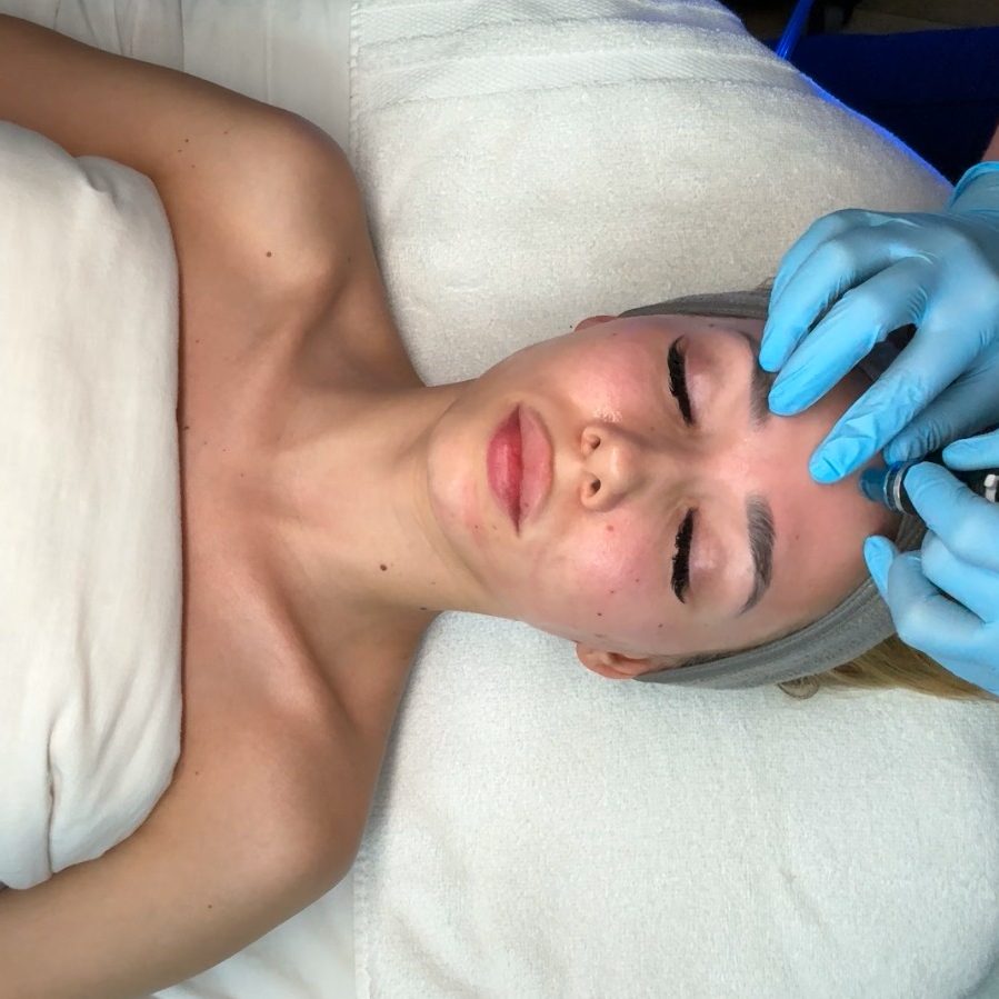 Hydrafacial at SDBotox