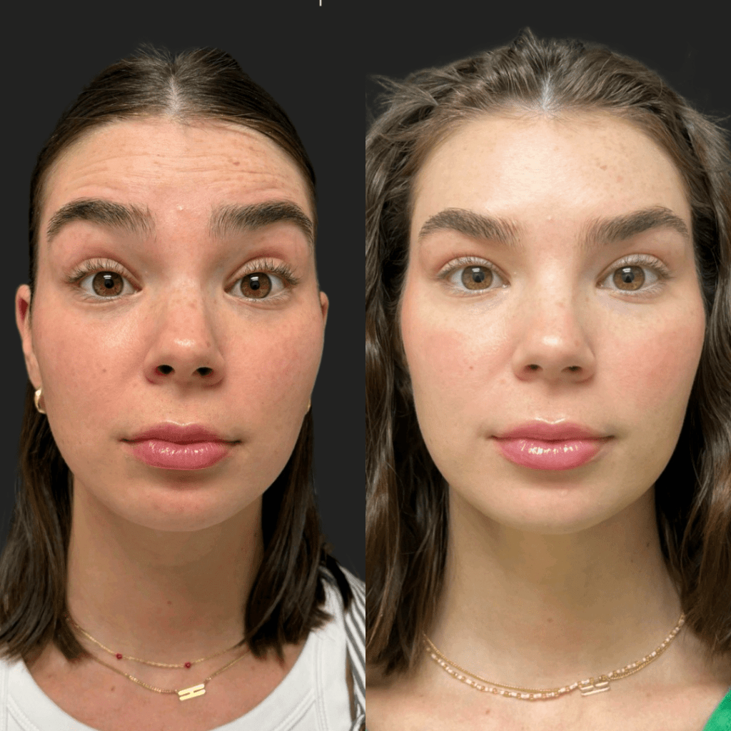 Botox before and after